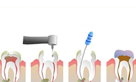 Une nouvelle procédure dentaire pourrait remplacer le traitement endodontique