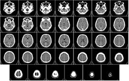La régénérescence des neurones est possible