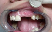 Implants antrieurs chez un patient au sourire dit gingival