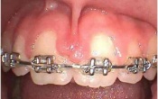 La chirurgie pr-orthodontique