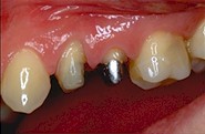 Les dents sont prpares avec les deux techniques de reconstitution dcrites plus haut.