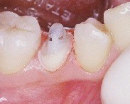 Un matriau composite est foul dans la dent et autour de la vis, un moignon est ainsi reconstitu.
