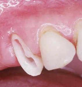Premire sance : Prparation, prise dempreinte et ralisation d'une dent provisoire