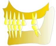 La premire molaire suprieure est descendue de faon telle qu'elle devra tre extraite.