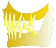 Une deuxime dent du haut aprs tre trop descendue, devra tre extraite  son tour. Le remplacement des dents sera techniquement plus difficile.