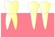 Une dent doit tre extraite, il s'agit ici de la premire molaire.