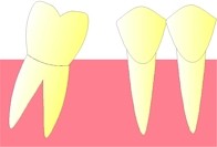 La dent se trouvant en arrire de la dent extraite, commence  se coucher vers l'avant (version).