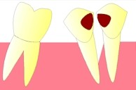 Cette accumulation d'aliments et de bactries pourra provoquer une perte de l'os qui soutient la dent (atteinte parodontale).