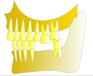 Si la deuxime prmolaire du bas est manquante, la molaire du haut n'a plus du tout d'appui et rgresse vers le bas. Il n'y a plus d'auto-nettoyage par la mastication, la dent va se carier et se recouvrir de tartre.