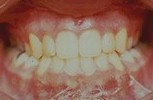 Aprs traitement chirurgical et orthodontique