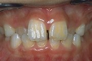 Invers d'articul : les dents suprieures doivent circonscrire les dents infrieures.
