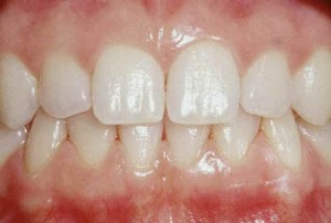 Une gencive saine est rose, adhre  la dent et ne saigne pas.