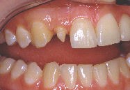 Incisive latrale atteinte de microdontie (dent naine).