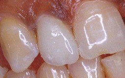Dent atteinte de microdontie reconstitue par une facette.