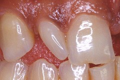 Dent atteinte de microdontie.