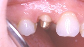 Aprs cicatrisation, le dentiste peut reconstituer la dent avec un inlay-core et une couronne.