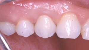 Aprs cicatrisation, le dentiste peut reconstituer la dent avec un inlay-core et une couronne.
