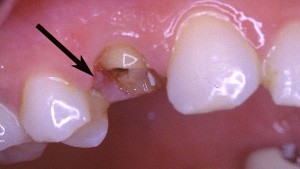Cette premire prmolaire du haut a t dtruite par la carie. Il ne reste pas suffisamment de structure dentaire pour faire tenir une couronne.