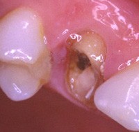Aprs nettoyage et suppression des parties fragiles, on peut remarquer que la structure rsiduelle dentaire est sous le niveau de la gencive. 