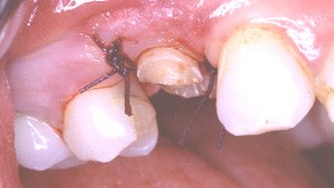 L'longation coronaire consiste donc  un repositionnement de la gencive, afin de dgager d'avantage la structure dentaire.