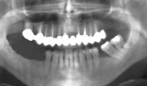 Trois dents sont manquantes au maxillaire infrieur.