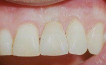 Remplacement d'une dent unitaire (pas de mutilation des dents voisines)