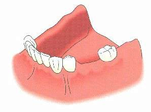 Remplacement de plusieurs dents manquantes par un bridge sur implants (vite l'appareil amovible) (dessins Nobel Biocare)
