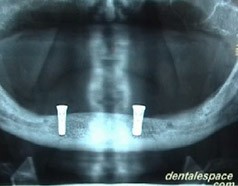 Radiographie aprs la pose de 2 implants.