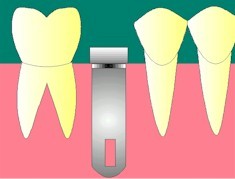 La chirurgie en un temps:
<br>L'implant est pos. Une vis de cicatrisation merge de la gencive. Dans certains cas, de plus en plus rares, l'implant est compltement enfouie sous la gencive, ce qui ncessite alors un deuxime temps opratoire. 
<br>
<br>