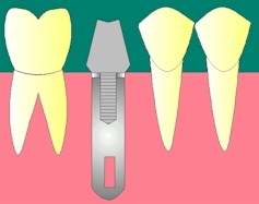 Premier temps prothtique: 
<br>Pose de l'inlay-core implantaire viss dans le corps de l'implant.
<br>