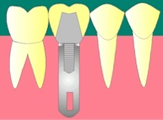 Deuxime temps prothtique:
<br>Pose de la couronne sur l'inlay-core.
<br>