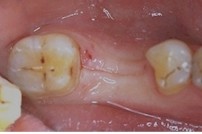 Rduction  minima des dents voisines de la dent manquante.