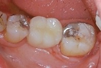 Les ailettes sont colles sur la face linguale des dents.