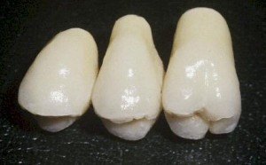 Le bridge joue un double rle : il couronne les dents abmes et remplace la dent manquante.