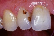 Restauration au composite dans le cas d'une dent antrieure.