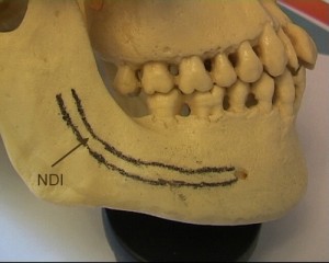 Le Nerf Dentaire Infrieur (NDI) chemine  l'intrieur de l'os.