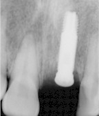 L'implant est pos. Contrairement au bridge, il n'y a pas de mutilation des dents voisines.