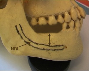 Les 2 molaires sont absentes. La hauteur osseuse disponible est matrialise par la flche.