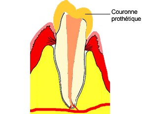 Habituellement la dent est ensuite couronne. Le canal tant compltement obtur, les bactries limines, la dent ne posera pas de problme infectieux, mme plusieurs annes aprs.