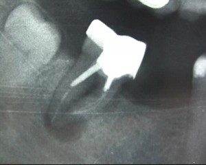 Cette dent couronne depuis plusieurs anne prsente une importante lsion  l'extrmit de la racine. 
<br>Cette lsion est reste silencieuse et a t dcouverte fortuitement lors d'un examen radiologique.