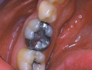 Cette dent dvitalise prsente une grosse reconstitution avec un amalgame. Le patient a ressenti une vive douleur au cours d'un repas.