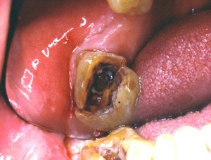 Voici un autre cas de fracture de dent dvitalise. Cette dent devra tre extraite.