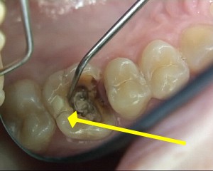 Avec la sonde, nous pouvons carter le morceau fractur. La flche montre le trait de fracture.
<br>Cette dent sera extraite.