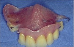 Plaque de rsine plus ou moins volumineuse selon le nombre de dents  remplacer. Sa tenue est assure par des crochets en fil mtallique.