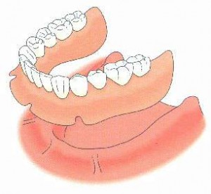 La prothèse dentaire amovible (Dentier) → Dentiste à Bron - Dr Pagliano